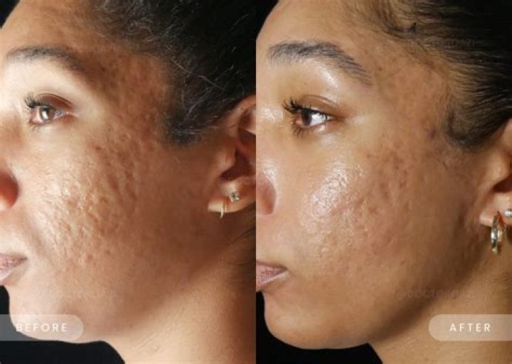 Are acne scars permanent?