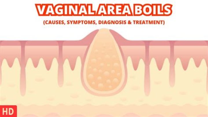 Are boils and abscess the same thing?