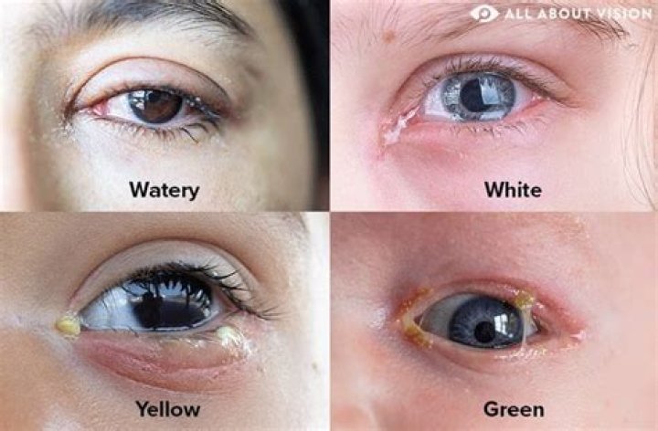 Are eye boogers normal?