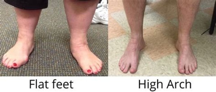Are flat feet a disability?