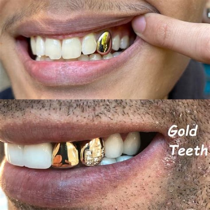 Are gold teeth worth it?