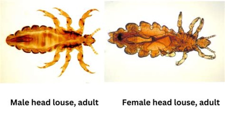 Are head lice embarrassing?