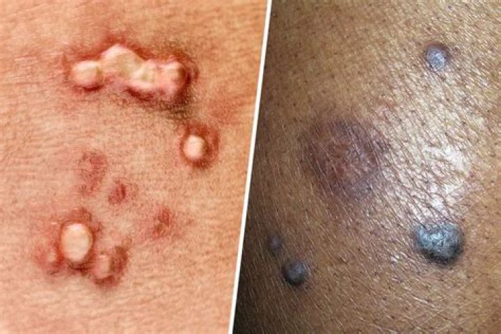 Are HPV 18 and 45 the same?