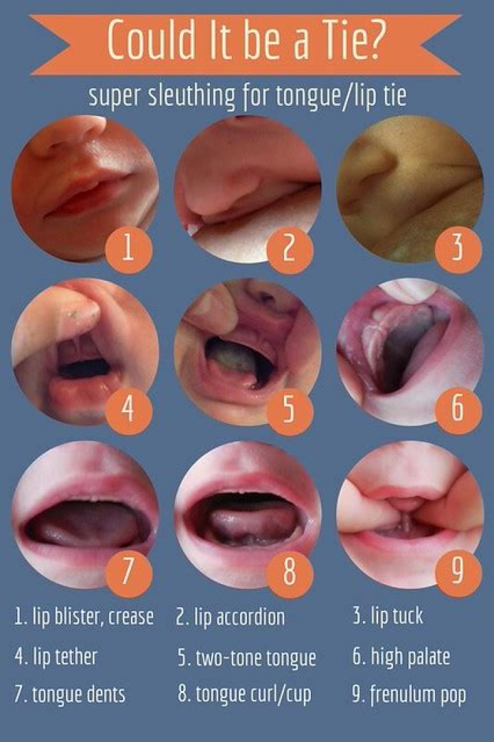 Are tongue ties genetic?