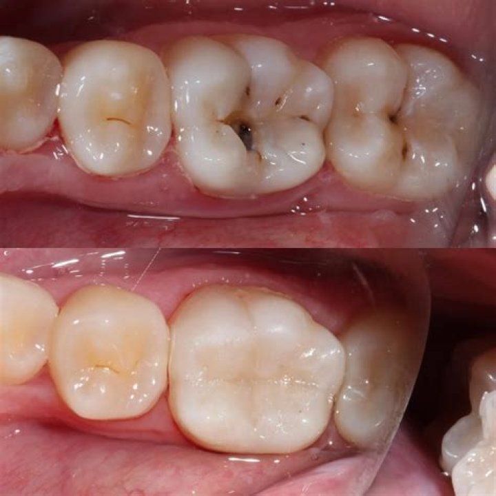 Are tooth fillings painful?