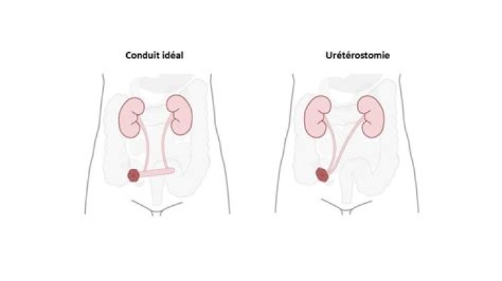 Are Urostomies permanent?