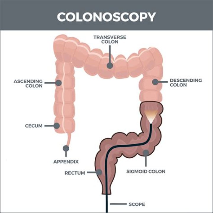 Are you awake during colonoscopy?