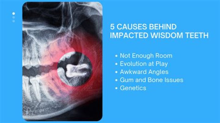 Can a 12 year old get wisdom teeth?
