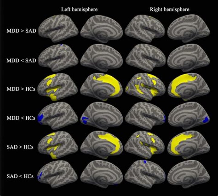Can a brain MRI show anxiety?