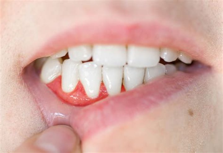Can a gum abscess burst on its own?