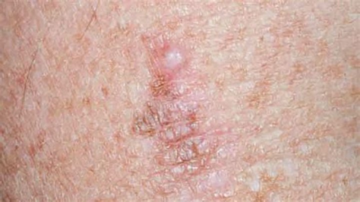 Can a melanoma just appear suddenly?
