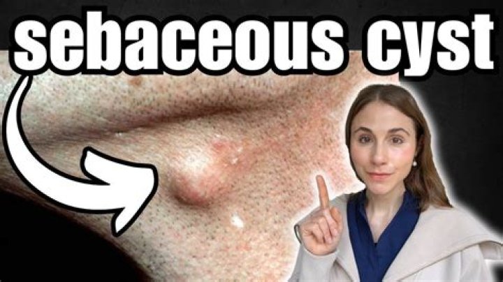 Can a sebaceous cyst pop on its own?