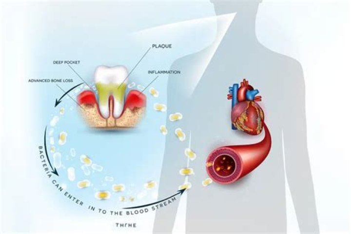 Can a tooth infection cause dizziness?