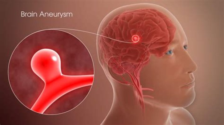 Can altitude cause an aneurysm?