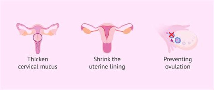 Can an IUD cause vision problems?