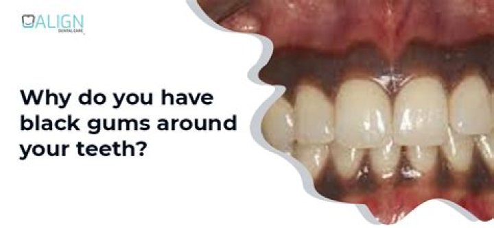 Can black gums turn pink again?