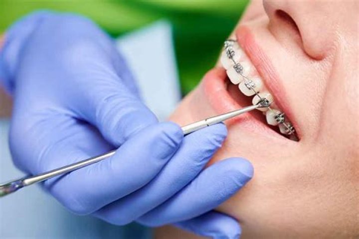 Can braces make teeth worse?