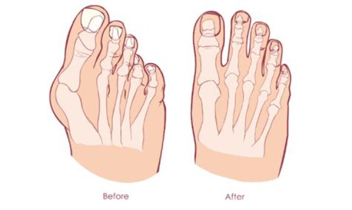 Can bunions be reversed?