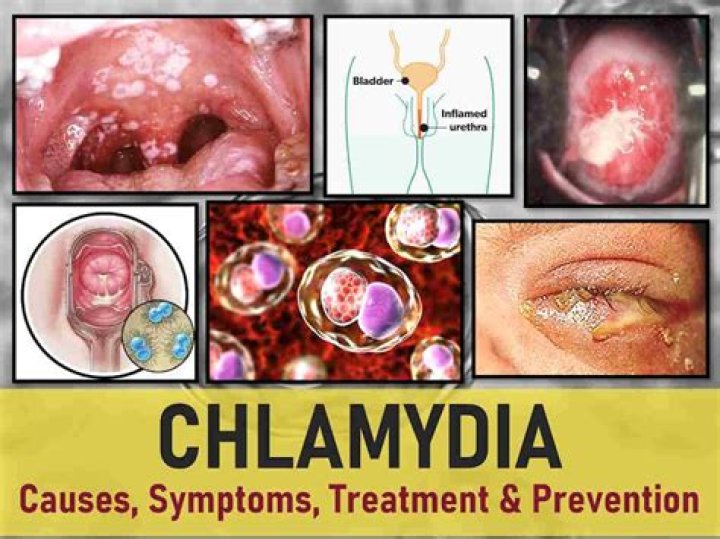 Can chlamydia cause itching?