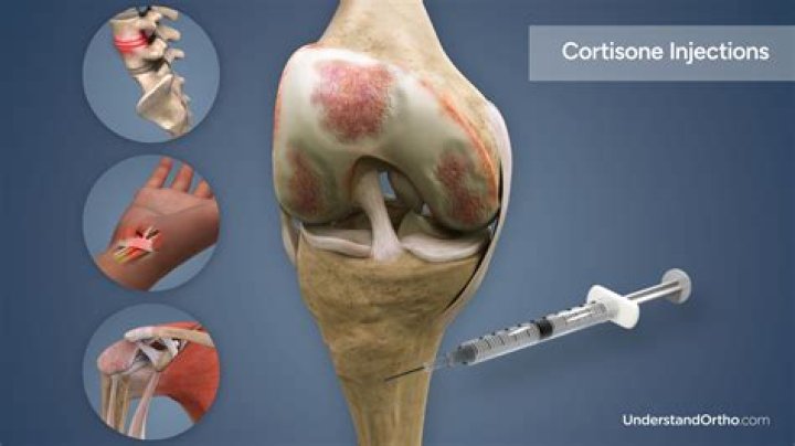 Can cortisone shots help neuropathy?