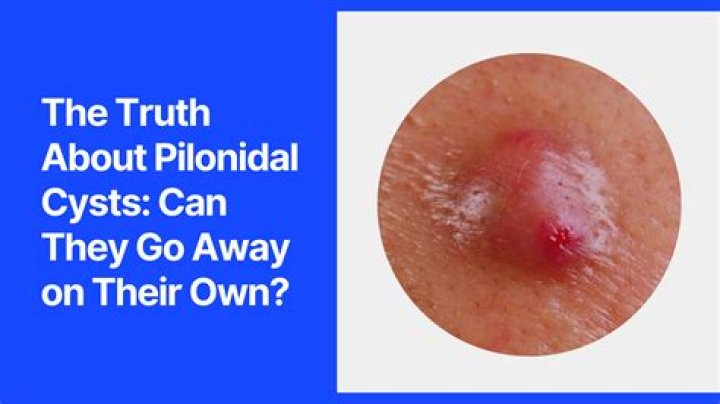 Can cysts in PCOS disappear?