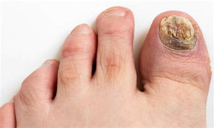 Can foot fungus spread to face?