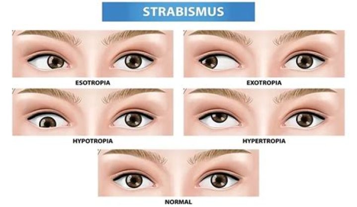 Can glasses cause strabismus?