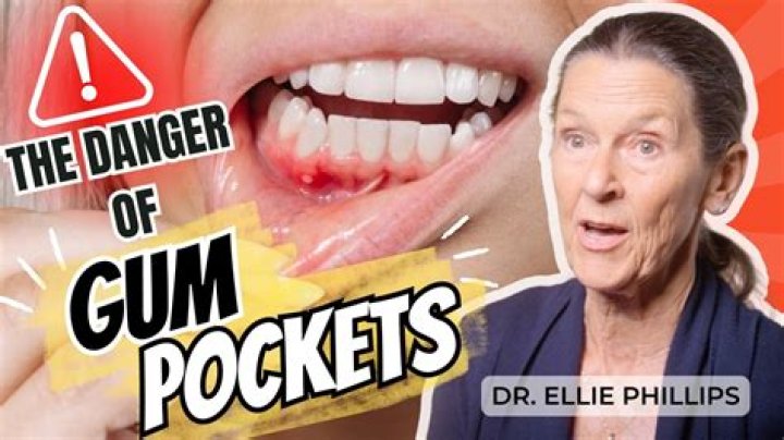 Can gum pockets shrink?