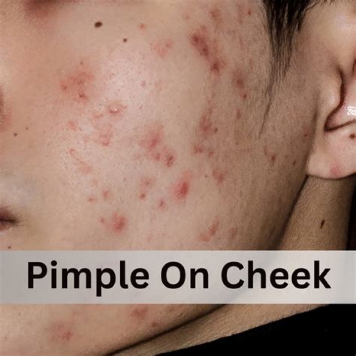 Can honey Cure Pimples?