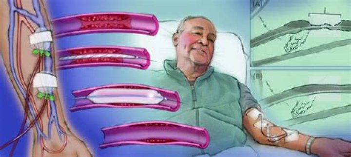 Can I drive after dialysis?