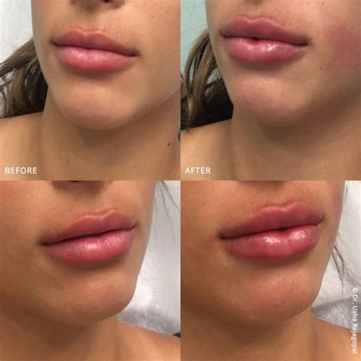 Can I eat after lip fillers?