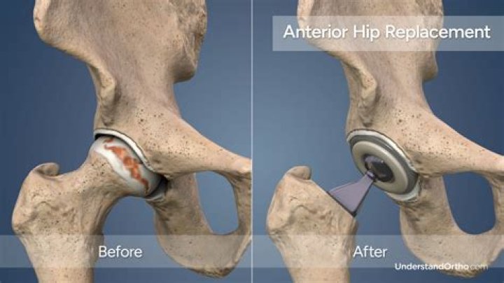 Can I sit Indian style after hip replacement?