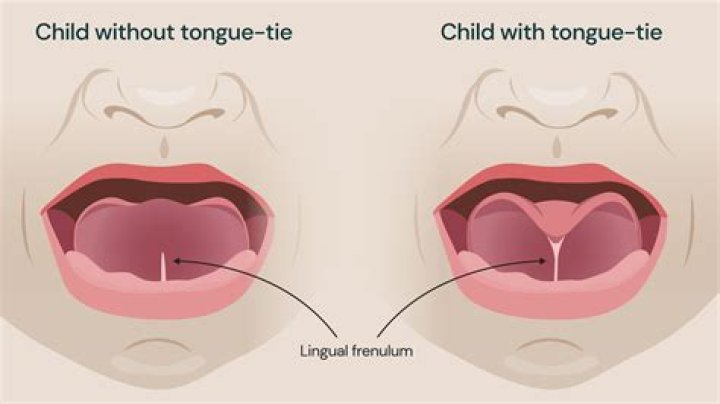 Can I talk without a tongue?