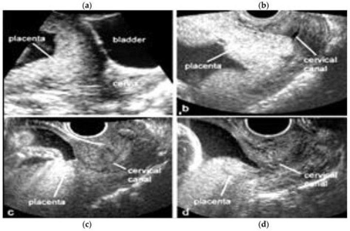 Can I use Indian toilet in low lying placenta?
