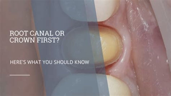 Can I wait a month to get a crown after root canal?