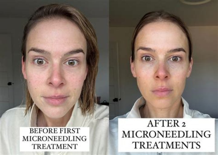 Can I wash my hair after microneedling face?