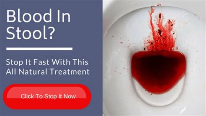 Can ibuprofen cause blood in stool?