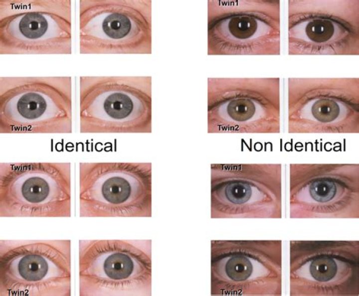 Can identical twins have different eye colors?