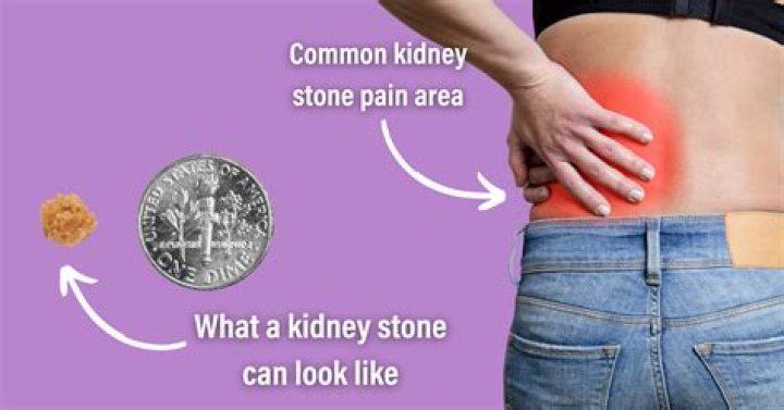Can kidney stones cause stomach ache?
