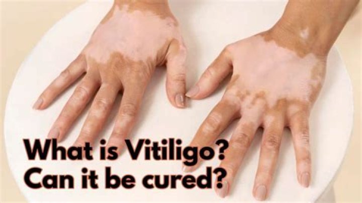 Can lip vitiligo be cured?