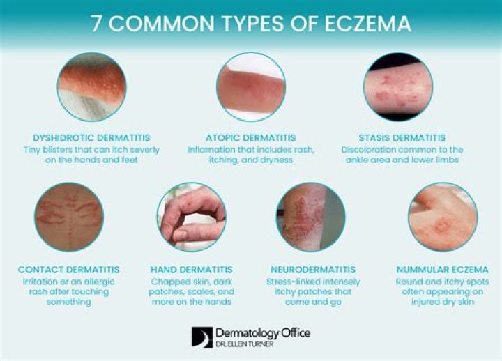 Can lotion make eczema worse?