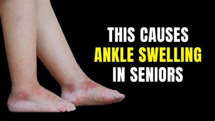 Can lots of walking cause swollen ankles?