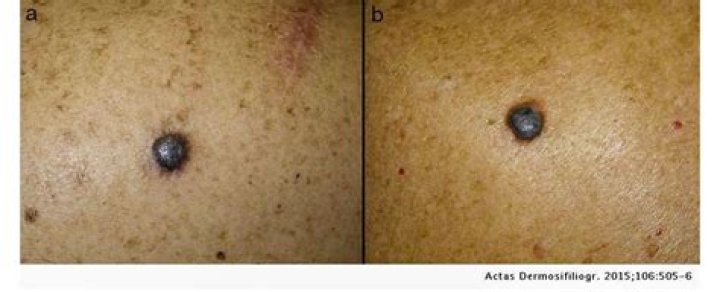 Can melanoma be a white spot?