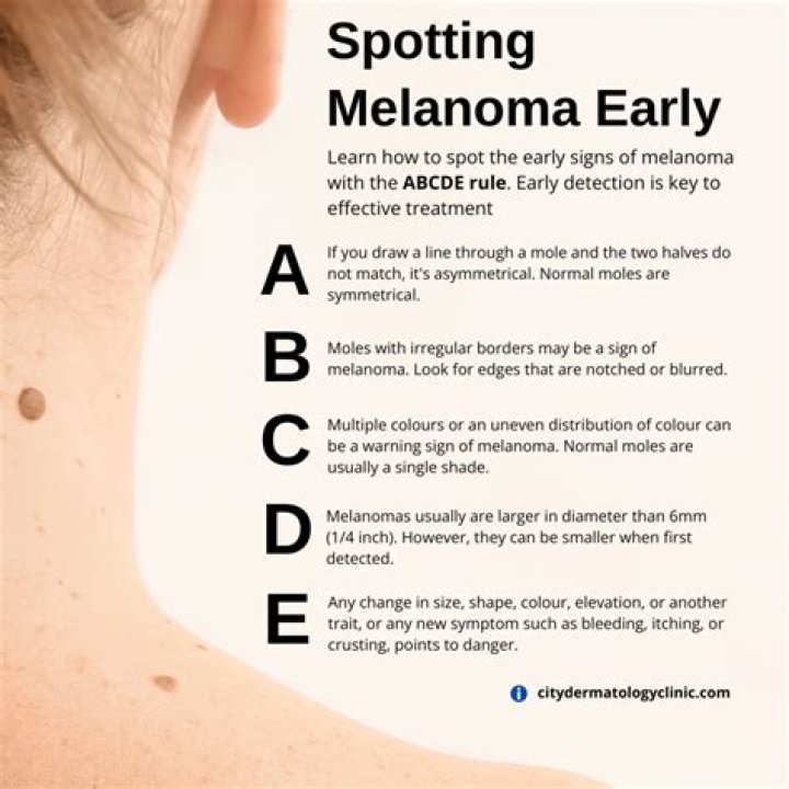 Can melanoma cause back pain?