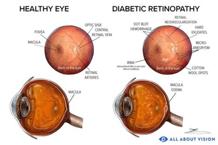 Can metformin affect eyesight?