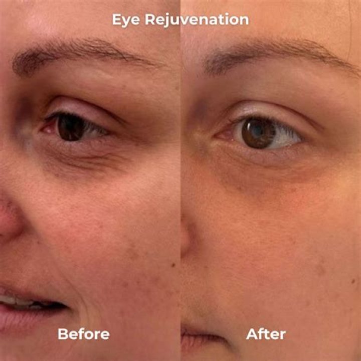 Can microneedling help droopy eyelids?
