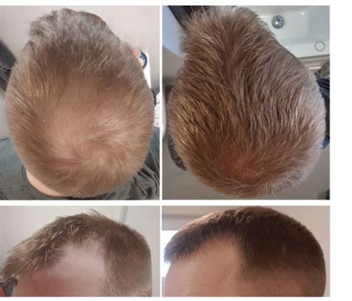 Can MS cause hair loss?