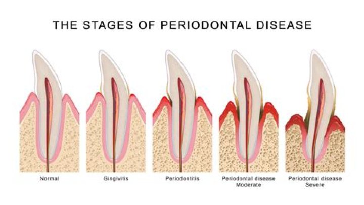 Can periodontal disease make you feel ill?