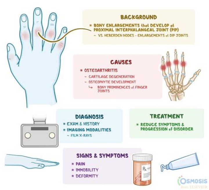 Can rheumatoid arthritis start suddenly?
