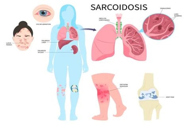 Can sarcoidosis cause tumors?
